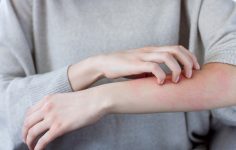 eczema no braço