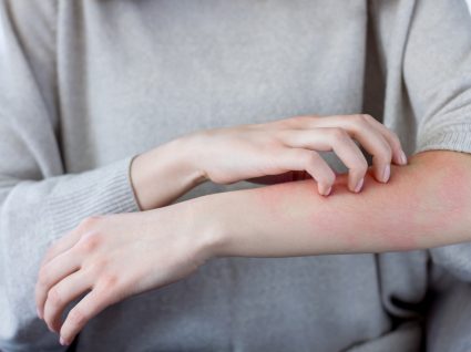 eczema no braço