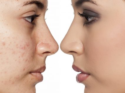 Aprenda como tratar cicatrizes de acne na pele