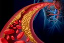 Arteriosclerose: a doença das artérias
