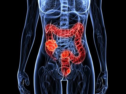 Cancro do intestino: tudo o que precisa de saber