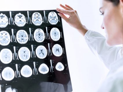 Sintomas de tumor cerebral que não deve ignorar