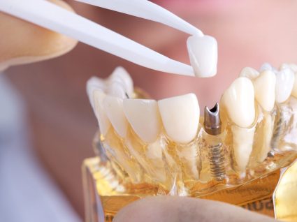 Saiba quanto custa um implante dentário