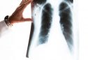 Doença Pulmonar Obstrutiva Crónica: o diagnóstico