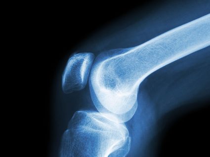 Causas e sintomas da artrite séptica