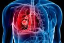 7 sintomas do cancro do pulmão
