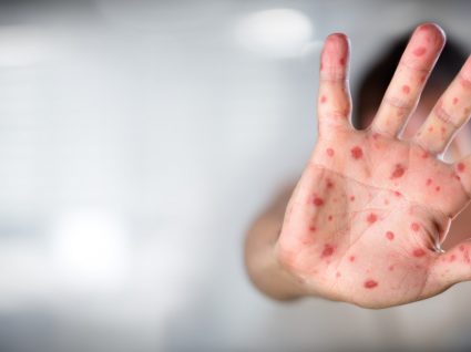 Autoridades de saúde declaram fim da epidemia de sarampo em Portugal