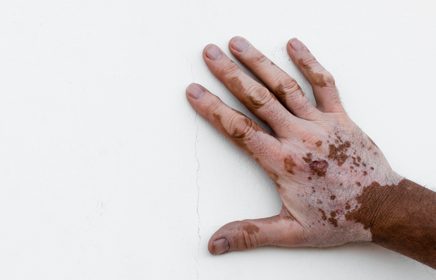 mão com vitiligo