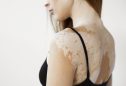 mulher com vitiligo nas costas