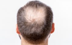 homem com alopecia